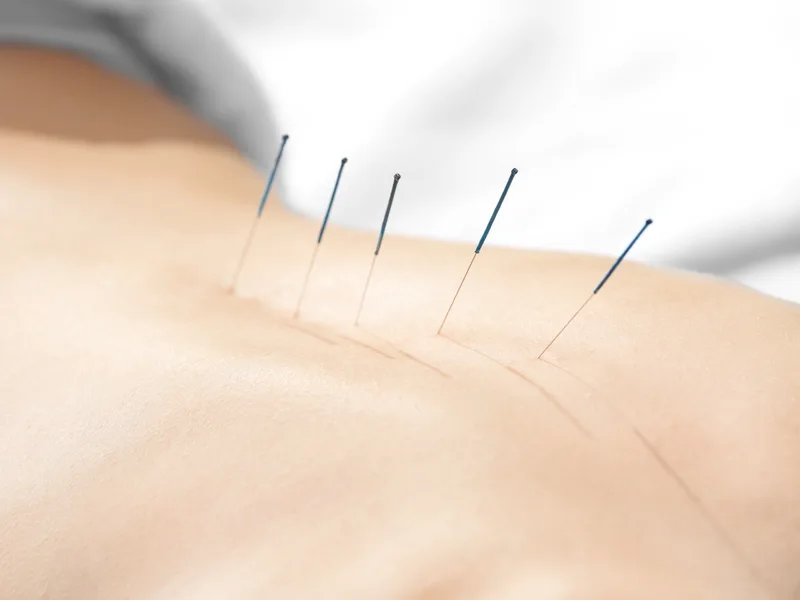 Acupuncture at Essential Life Chiropractic in Freehold