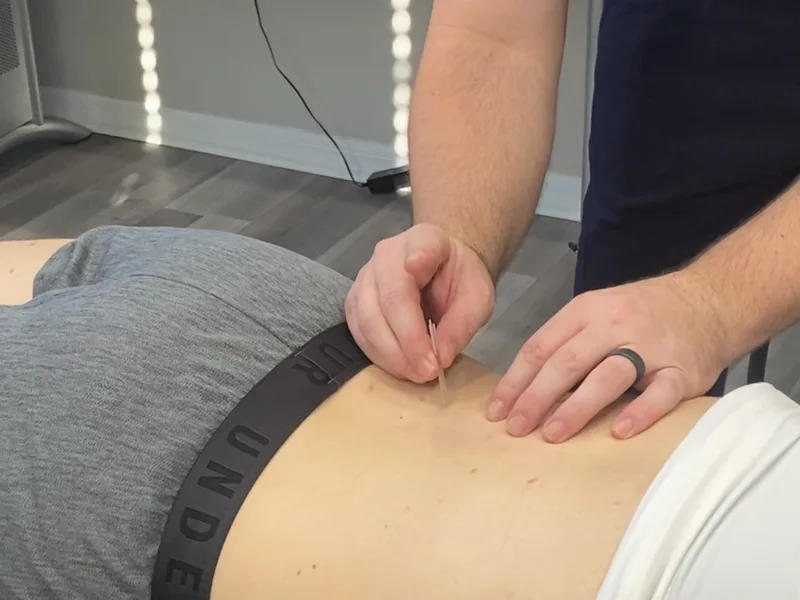 How Dry Needling works at Essential Life Chiropractic