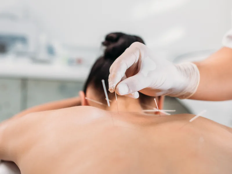 Dry Needling at Essential Life Chiropractic in Freehold
